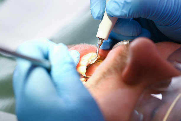 Best Emergency Root Canal Treatment in Harmony, RI